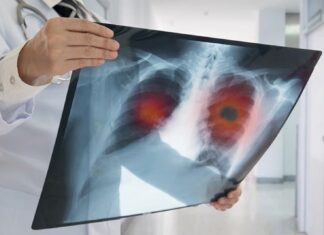 Terhimpit Biaya, Pasien Kanker Paru Berjuang Demi Akses Terapi Modern kanker paru